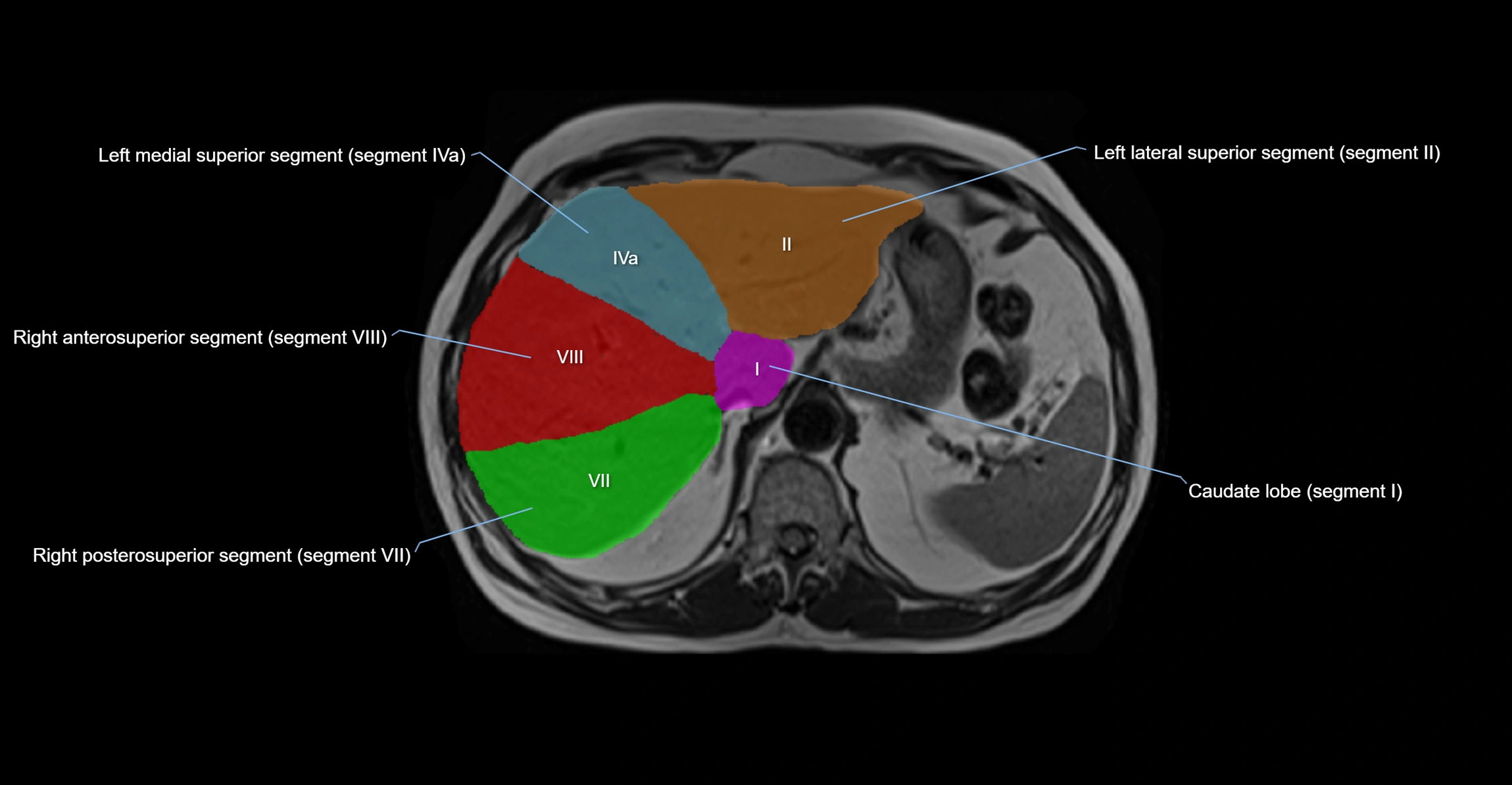 MRI  liver segments anatomy axial cross sectional 3T radiology  image-img-00001-00011.webp